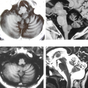 41歲延髓膠質瘤全切案例報告一則